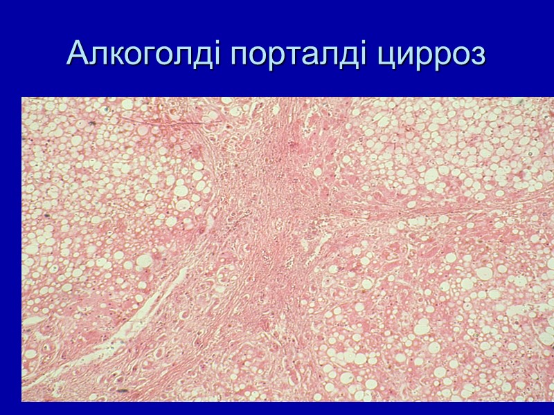 Алкоголді порталді цирроз